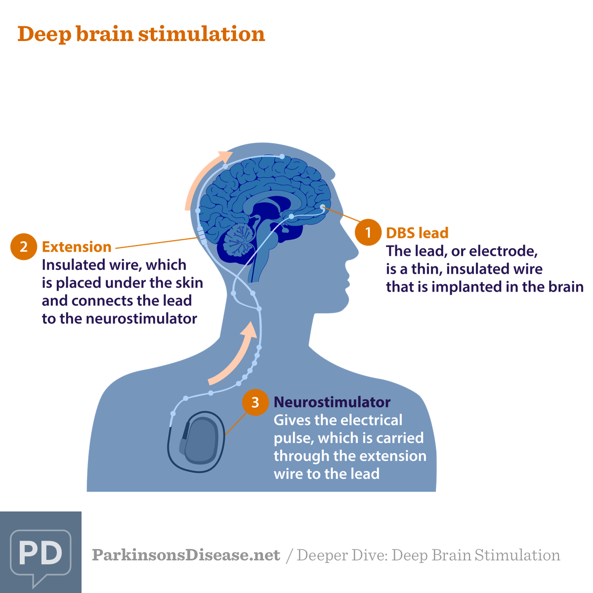 Components of deep brain stimulation, including the deep brain stimulation lead, extension, and neurostimulator