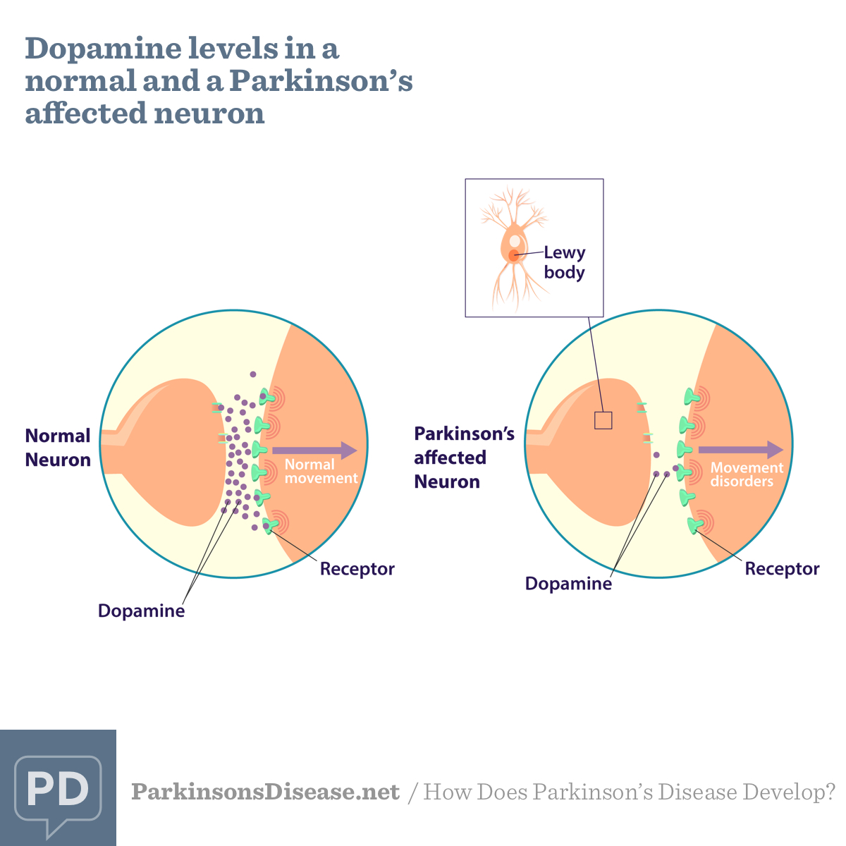 Dopamine & Parkinson's Disease: The Link Between