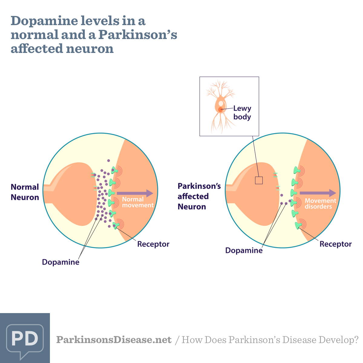 Dopamine levels in a normal neuron compared to a Parkinson's affected neuron